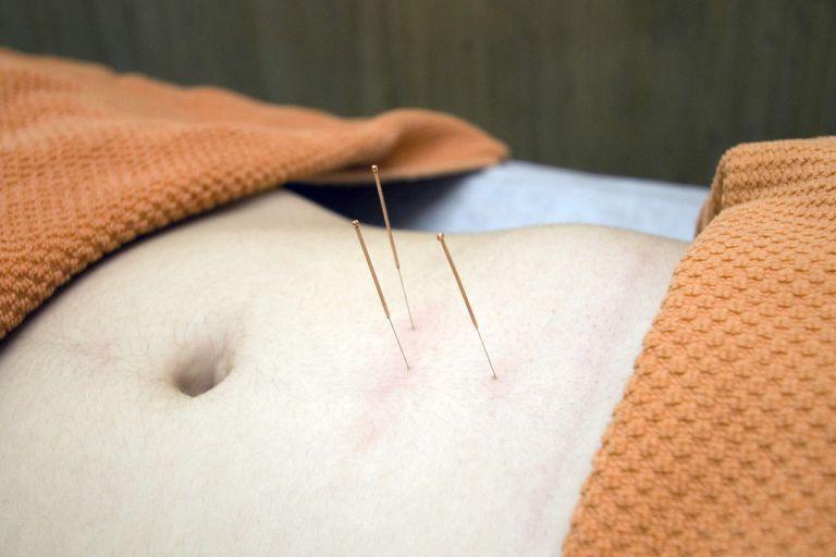 A Guide to Acupuncture: The Procedure, Risks, and Benefits