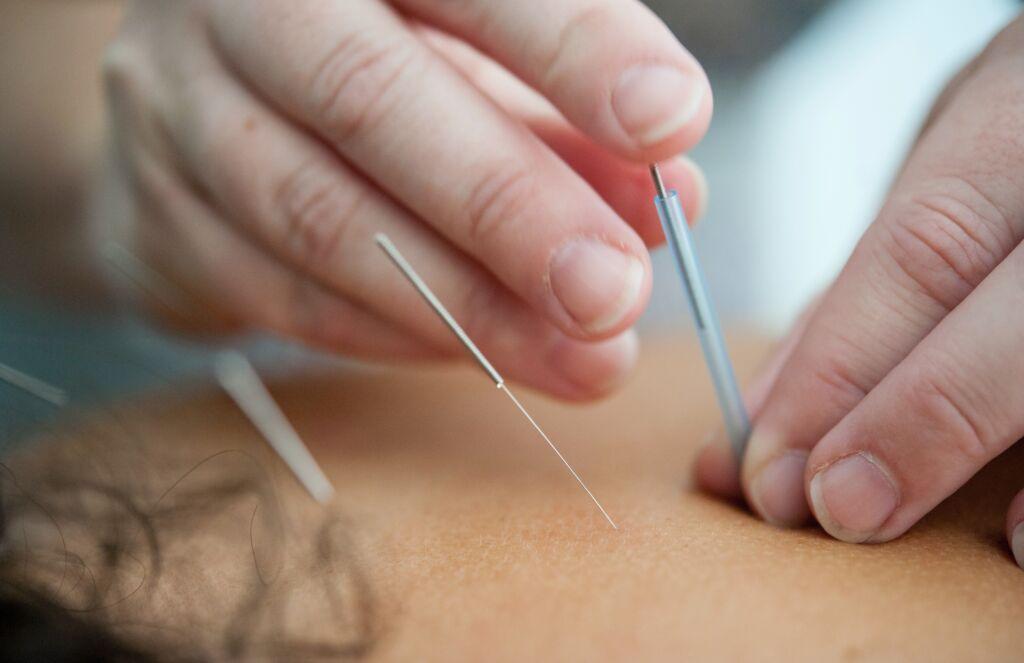 Specialist performing acupuncture on a patient